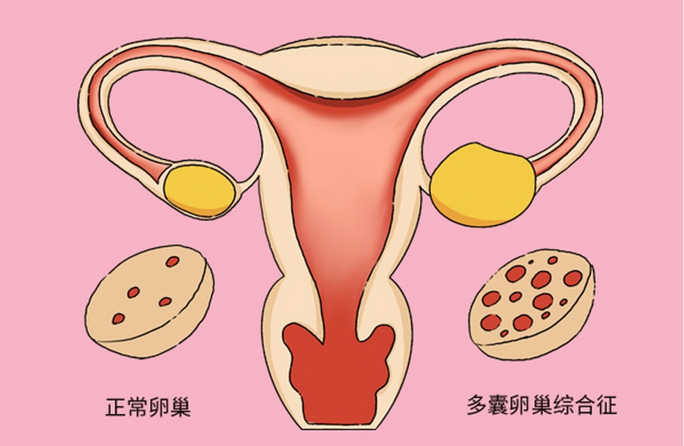 多囊卵巢综合征康复过程中的营养指导是什么？
